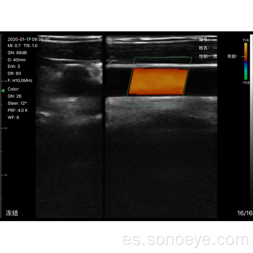 T ultrasonido inalámbrico vascular vascular y sonda longitudinal